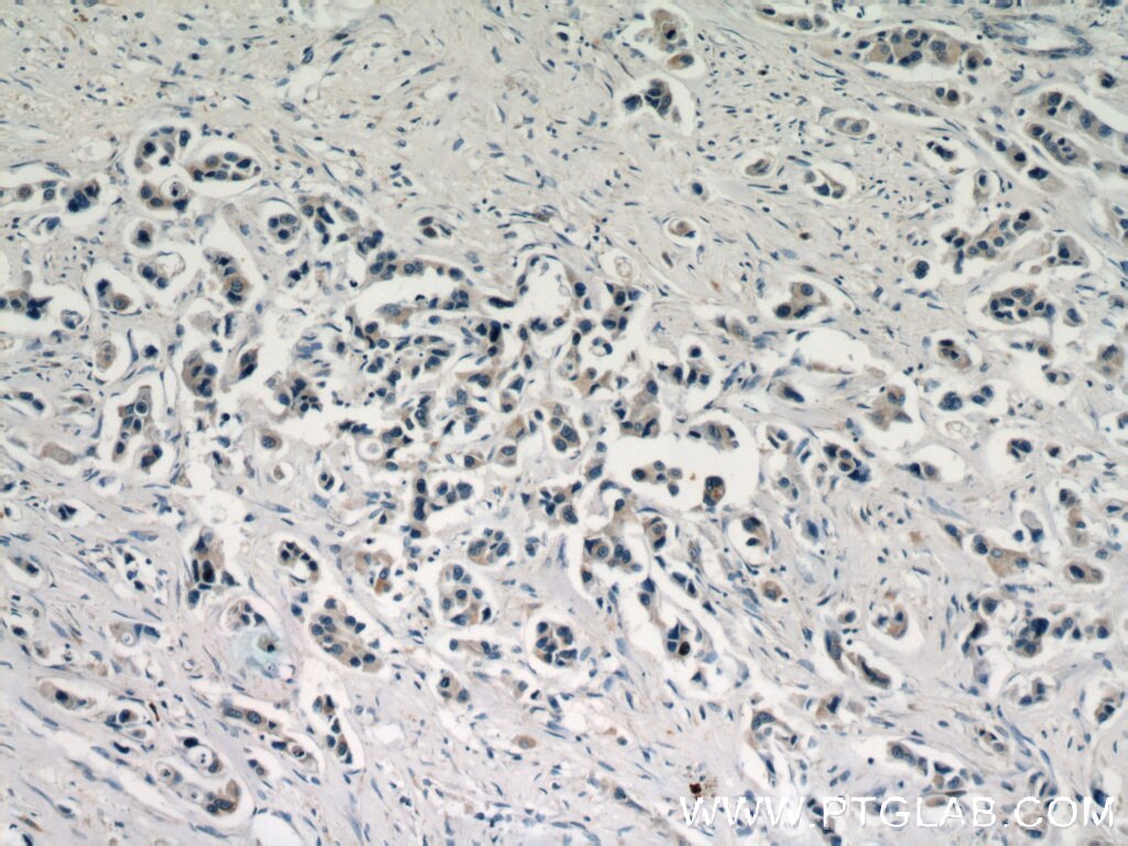 Immunohistochemistry (IHC) staining of human breast cancer tissue using C11orf70 Polyclonal antibody (20780-1-AP)