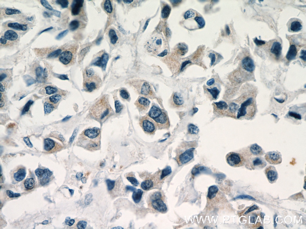 Immunohistochemistry (IHC) staining of human breast cancer tissue using C11orf70 Polyclonal antibody (20780-1-AP)