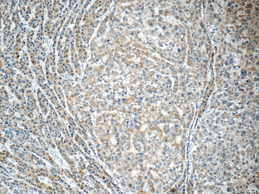 Immunohistochemistry (IHC) staining of human liver cancer tissue using C11orf74 Polyclonal antibody (25758-1-AP)
