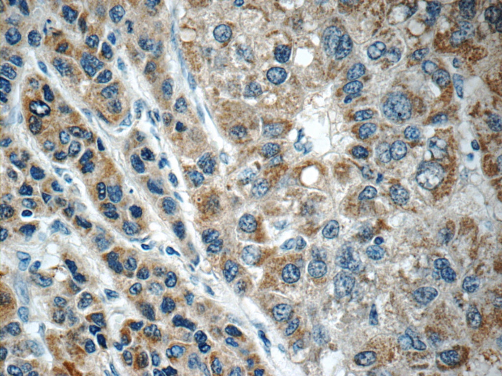 Immunohistochemistry (IHC) staining of human liver cancer tissue using C11orf74 Polyclonal antibody (25758-1-AP)