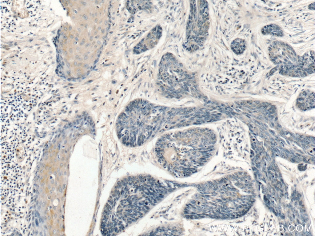 Immunohistochemistry (IHC) staining of human skin cancer tissue using SDH5 Polyclonal antibody (19906-1-AP)
