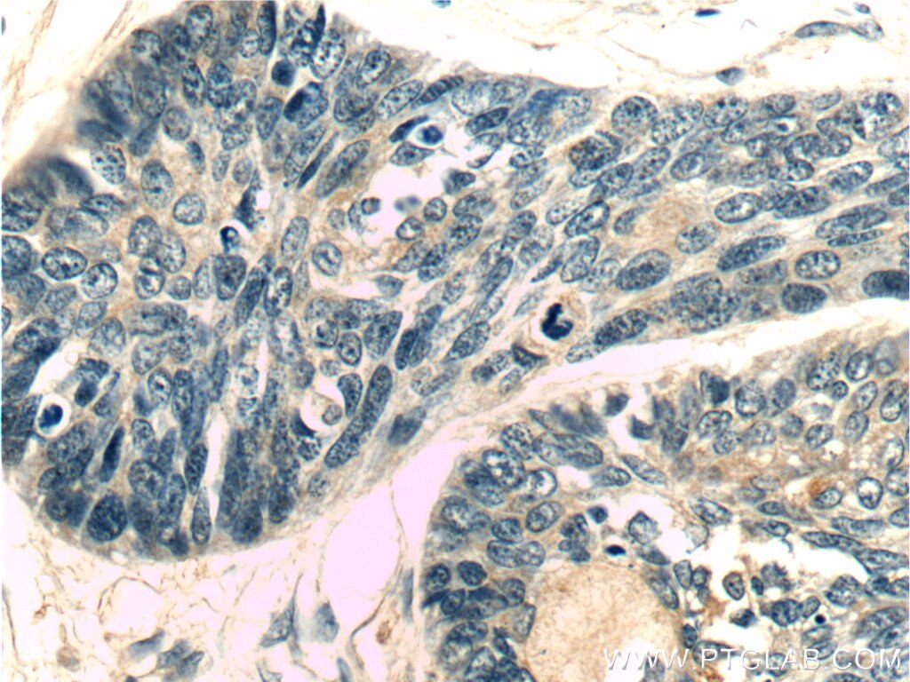 Immunohistochemistry (IHC) staining of human skin cancer tissue using SDH5 Polyclonal antibody (19906-1-AP)