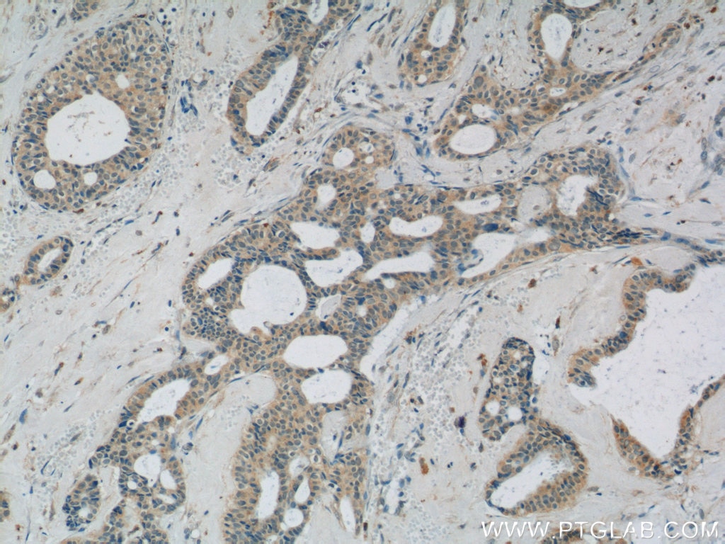 Immunohistochemistry (IHC) staining of human breast cancer tissue using C11orf83 Polyclonal antibody (25651-1-AP)