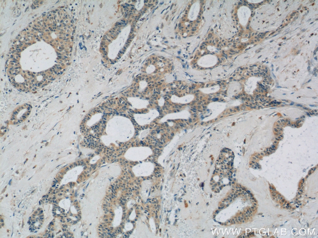 IHC staining of human breast cancer using 25651-1-AP