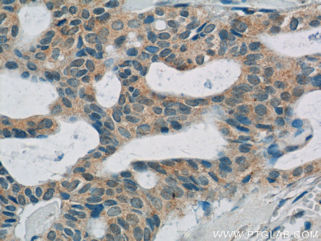 Immunohistochemistry (IHC) staining of human breast cancer tissue using C11orf83 Polyclonal antibody (25651-1-AP)