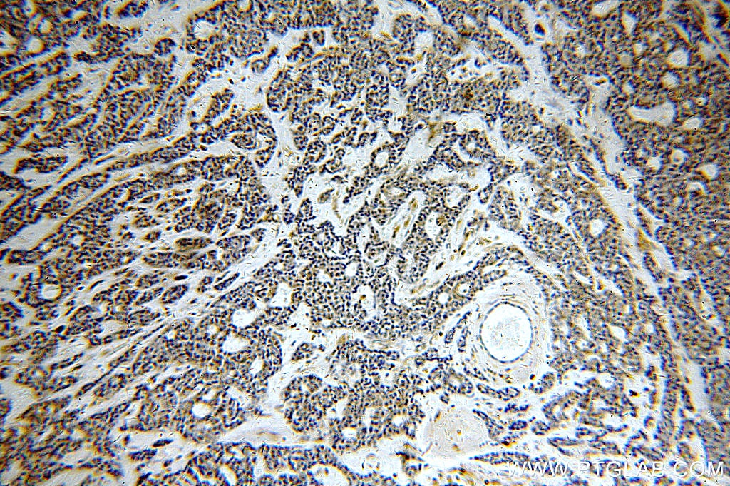 Immunohistochemistry (IHC) staining of human cervical cancer tissue using ASUN Polyclonal antibody (19892-1-AP)