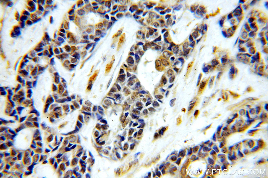 Immunohistochemistry (IHC) staining of human cervical cancer tissue using ASUN Polyclonal antibody (19892-1-AP)