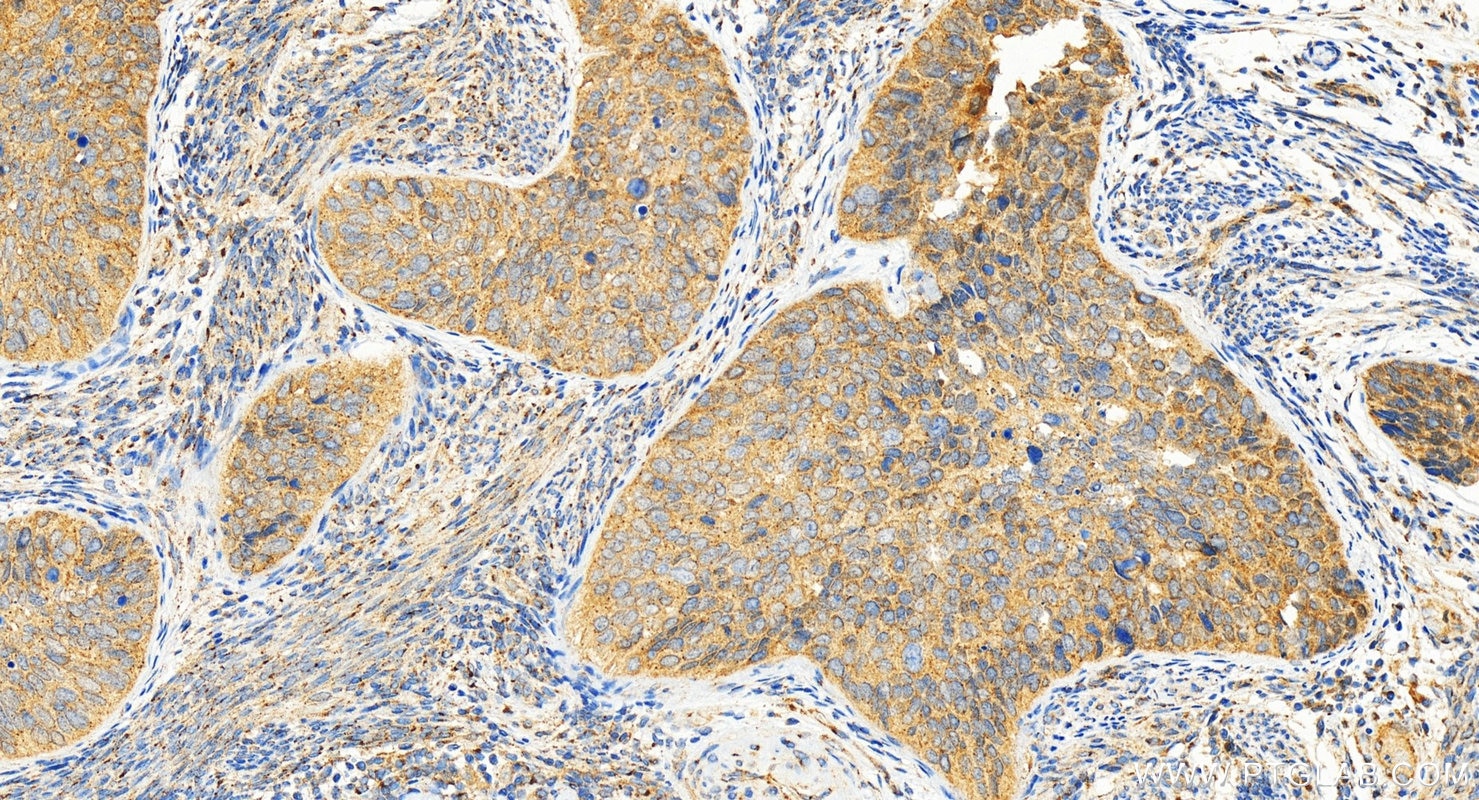 Immunohistochemistry (IHC) staining of human cervical cancer tissue using C12orf30 Polyclonal antibody (31748-1-AP)
