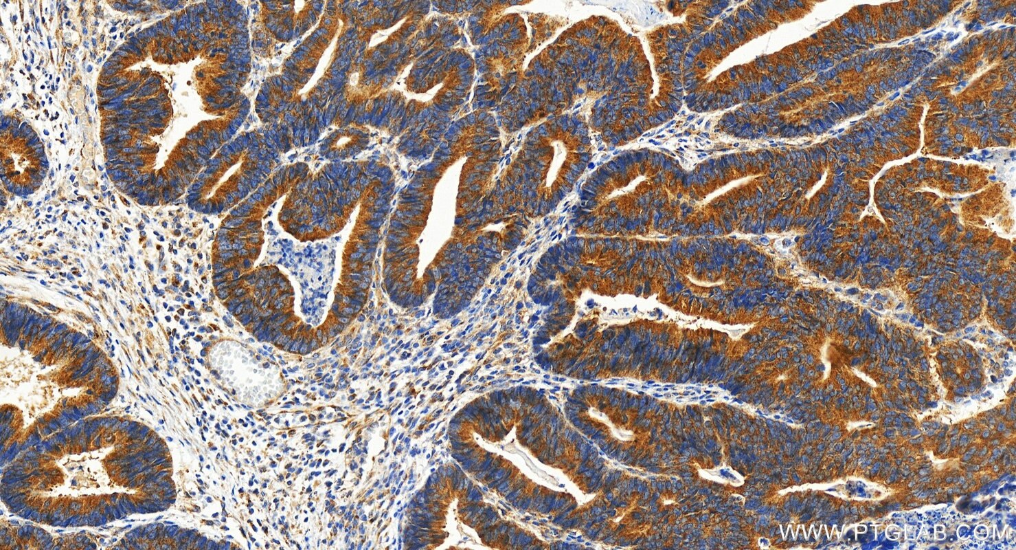 Immunohistochemistry (IHC) staining of human colon cancer tissue using C12orf30 Polyclonal antibody (31748-1-AP)