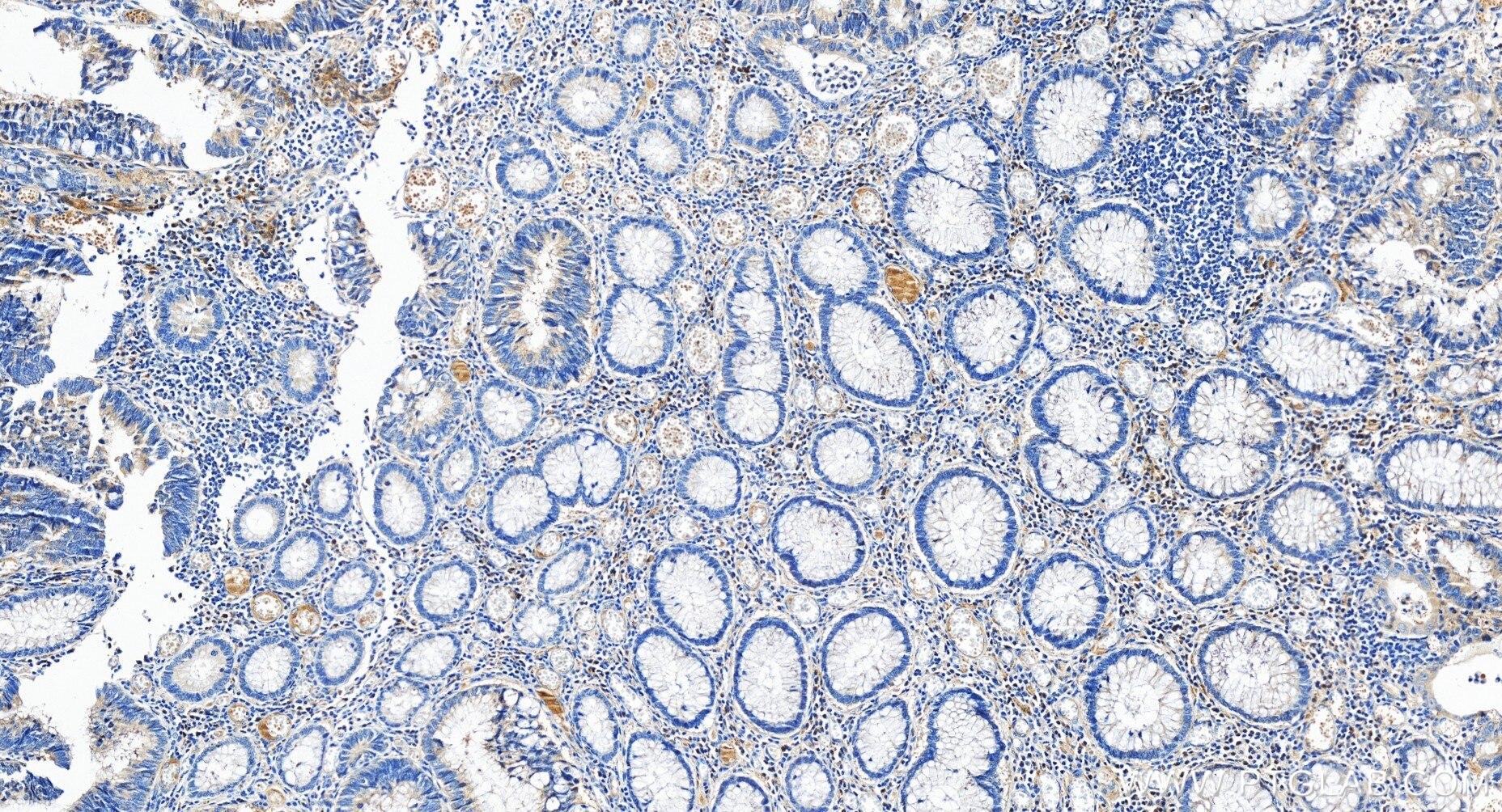 Immunohistochemistry (IHC) staining of human colon cancer tissue using C12orf51 Recombinant antibody (84641-1-RR)