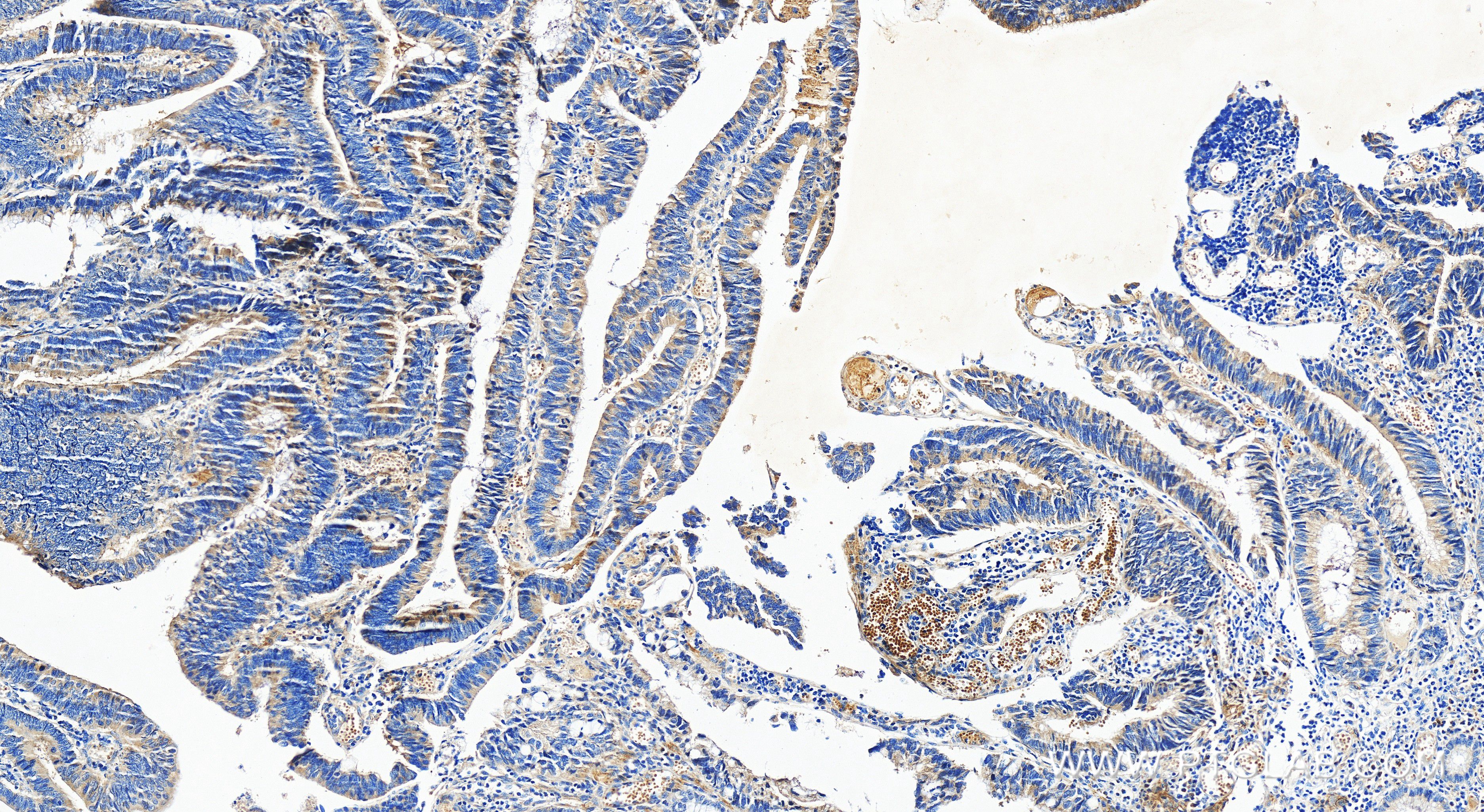 Immunohistochemistry (IHC) staining of human colon cancer tissue using C12orf51 Recombinant antibody (84641-1-RR)