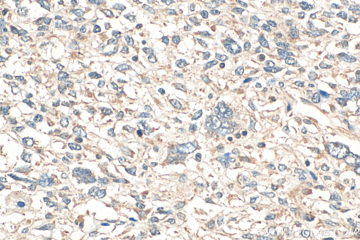 Immunohistochemistry (IHC) staining of human pancreas cancer tissue using MTRFR Polyclonal antibody (24646-1-AP)