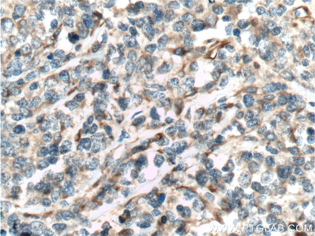 Immunohistochemistry (IHC) staining of human lymphoma tissue using C13orf1 Polyclonal antibody (26510-1-AP)