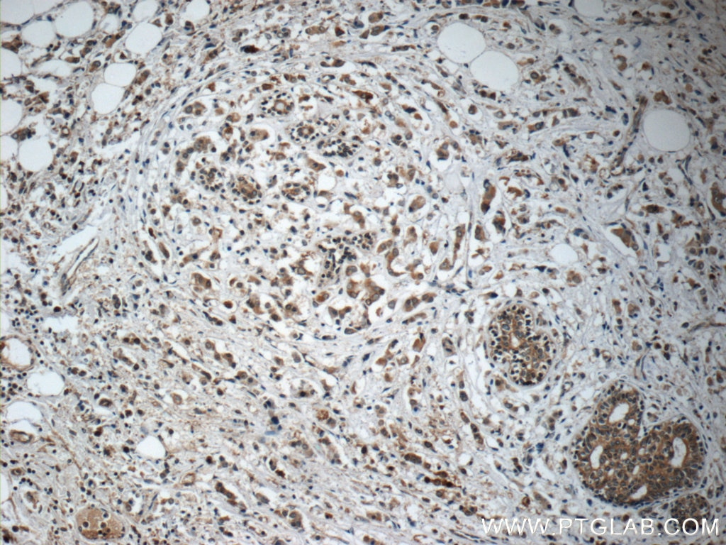 Immunohistochemistry (IHC) staining of human breast cancer tissue using C13orf37 Polyclonal antibody (24865-1-AP)