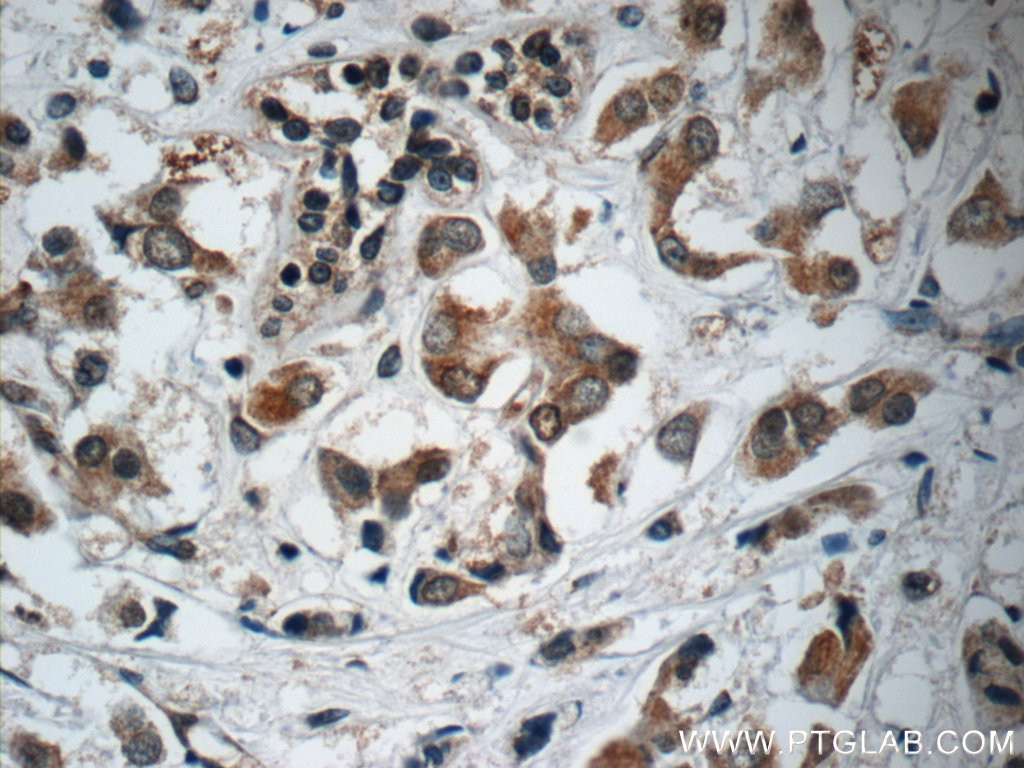 Immunohistochemistry (IHC) staining of human breast cancer tissue using C13orf37 Polyclonal antibody (24865-1-AP)