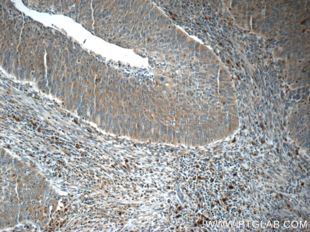 Immunohistochemistry (IHC) staining of human cervical cancer tissue using C13orf37 Polyclonal antibody (24865-1-AP)