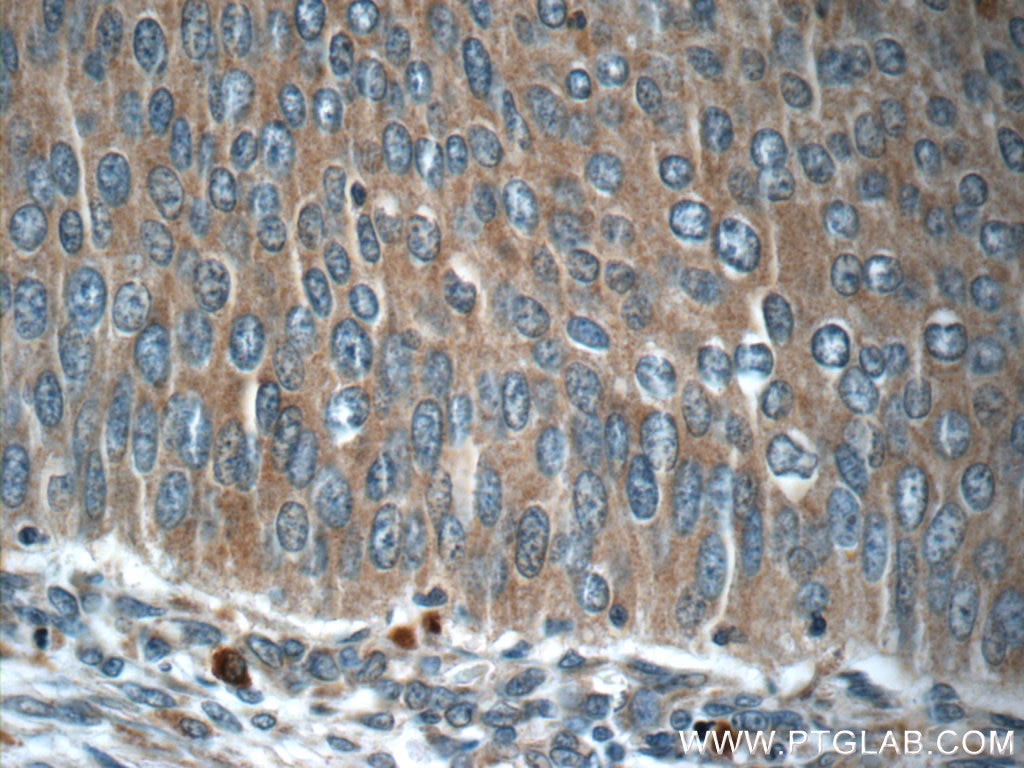 Immunohistochemistry (IHC) staining of human cervical cancer tissue using C13orf37 Polyclonal antibody (24865-1-AP)