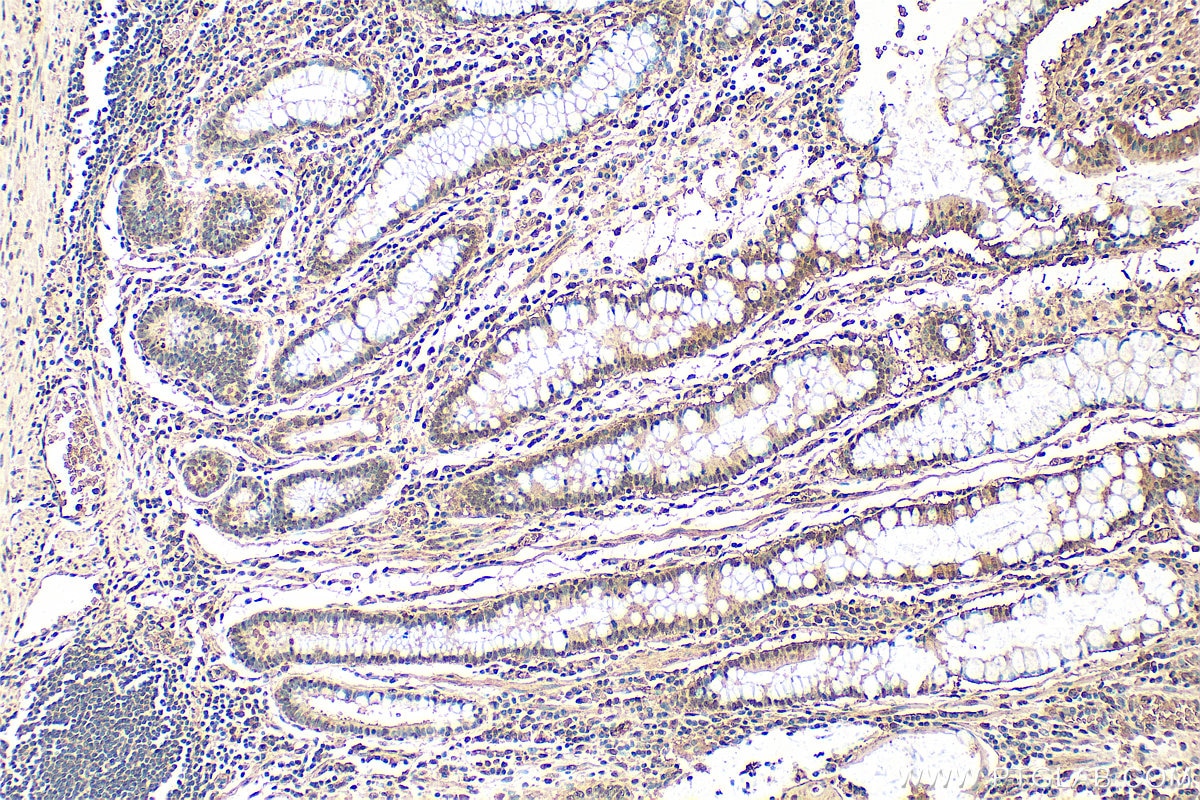 Immunohistochemistry (IHC) staining of human stomach cancer tissue using Vertnin Polyclonal antibody (24824-1-AP)