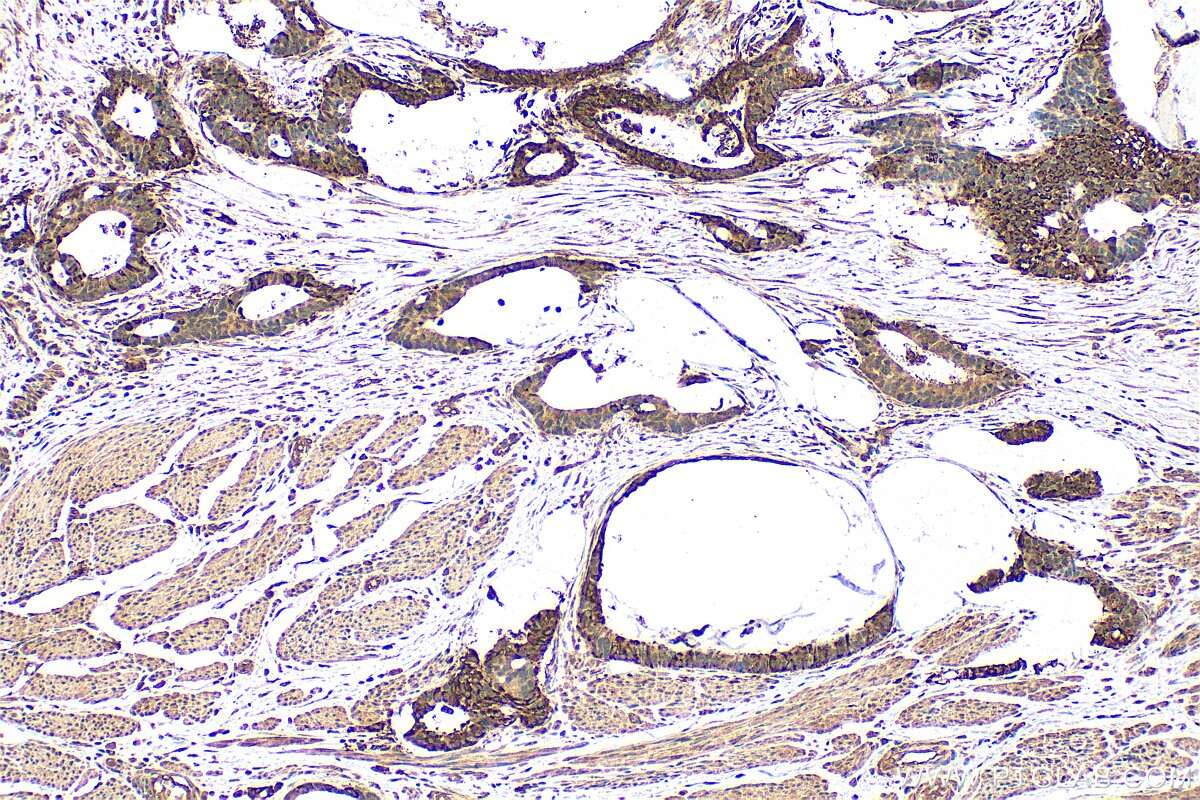 Immunohistochemistry (IHC) staining of human urothelial carcinoma tissue using Vertnin Polyclonal antibody (24824-1-AP)