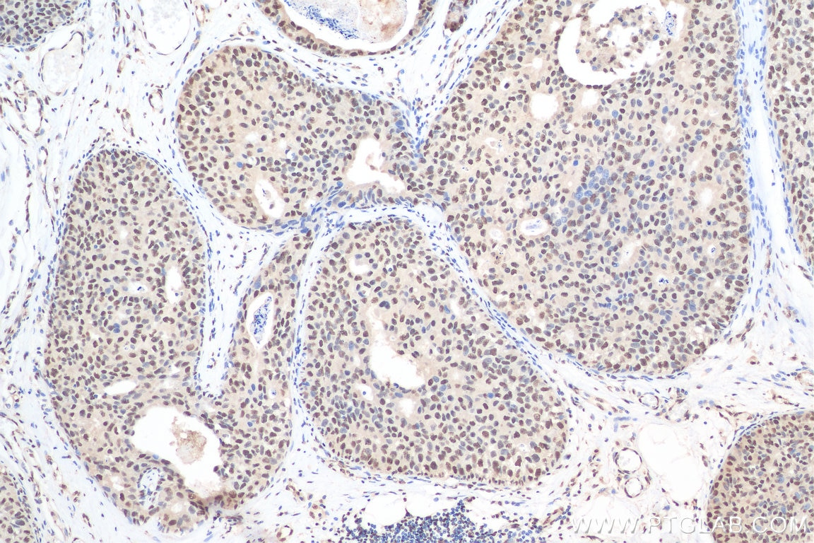Immunohistochemistry (IHC) staining of human breast cancer tissue using C14orf166 Polyclonal antibody (19848-1-AP)