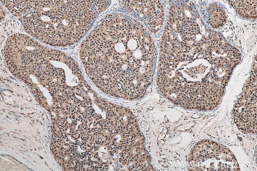 Immunohistochemistry (IHC) staining of human breast cancer tissue using C14orf166 Polyclonal antibody (19848-1-AP)