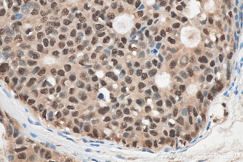 Immunohistochemistry (IHC) staining of human breast cancer tissue using C14orf166 Polyclonal antibody (19848-1-AP)