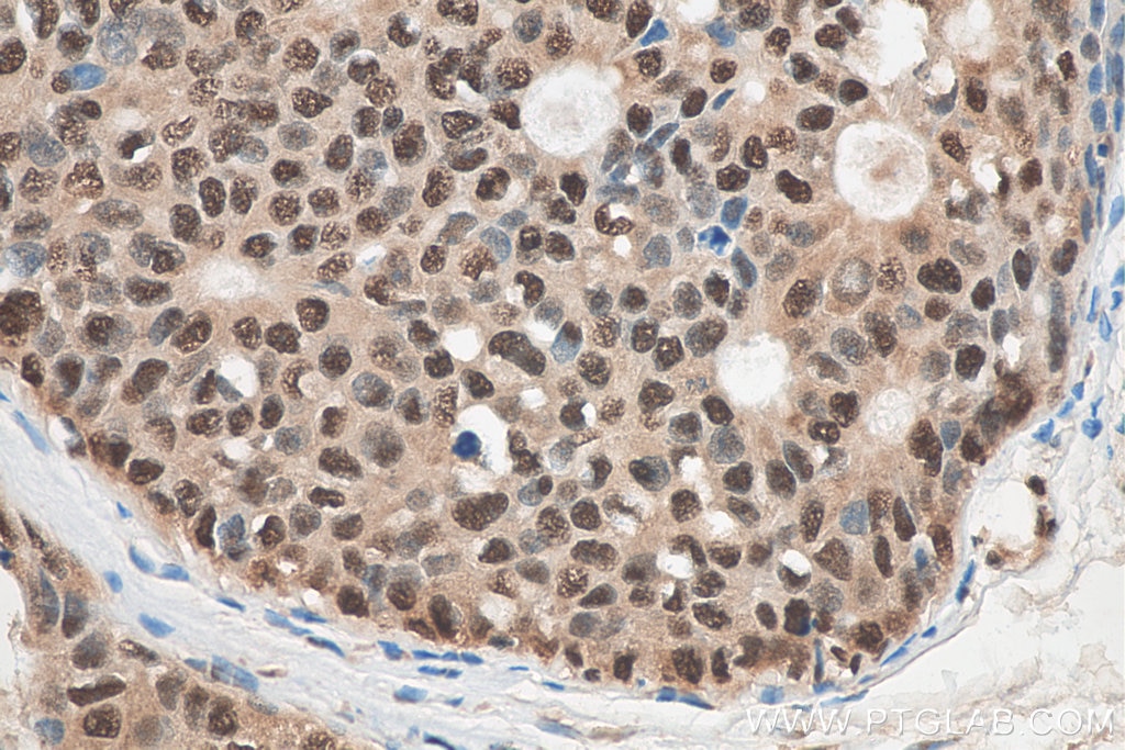 Immunohistochemistry (IHC) staining of human breast cancer tissue using C14orf166 Polyclonal antibody (19848-1-AP)