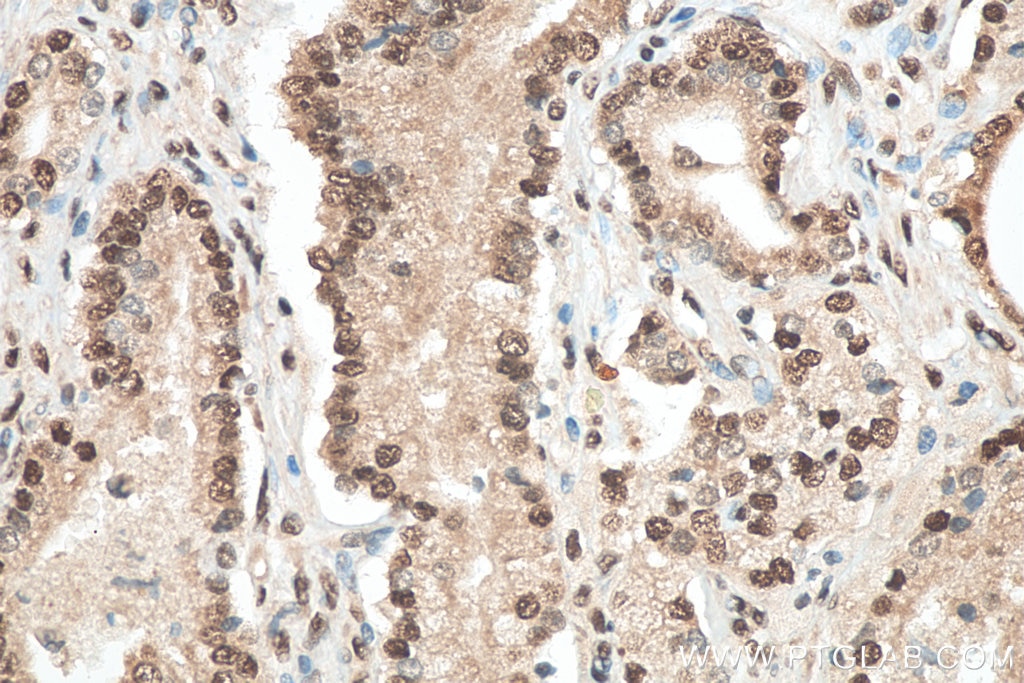 Immunohistochemistry (IHC) staining of human prostate cancer tissue using C14orf166 Polyclonal antibody (19848-1-AP)
