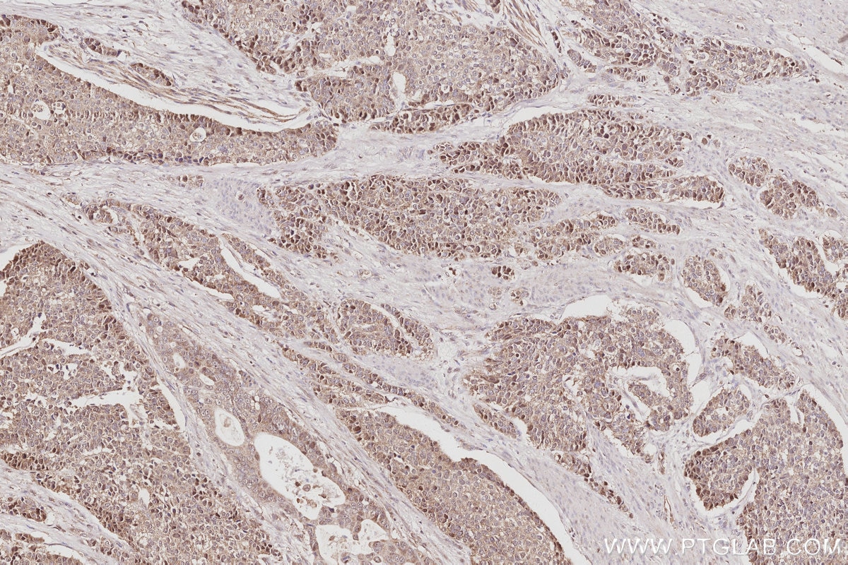 IHC staining of human stomach cancer using 26189-1-AP Immunohistochemistry (IHC) staining of human stomach cancer tissue using C15orf23 Polyclonal antibody (26189-1-AP)