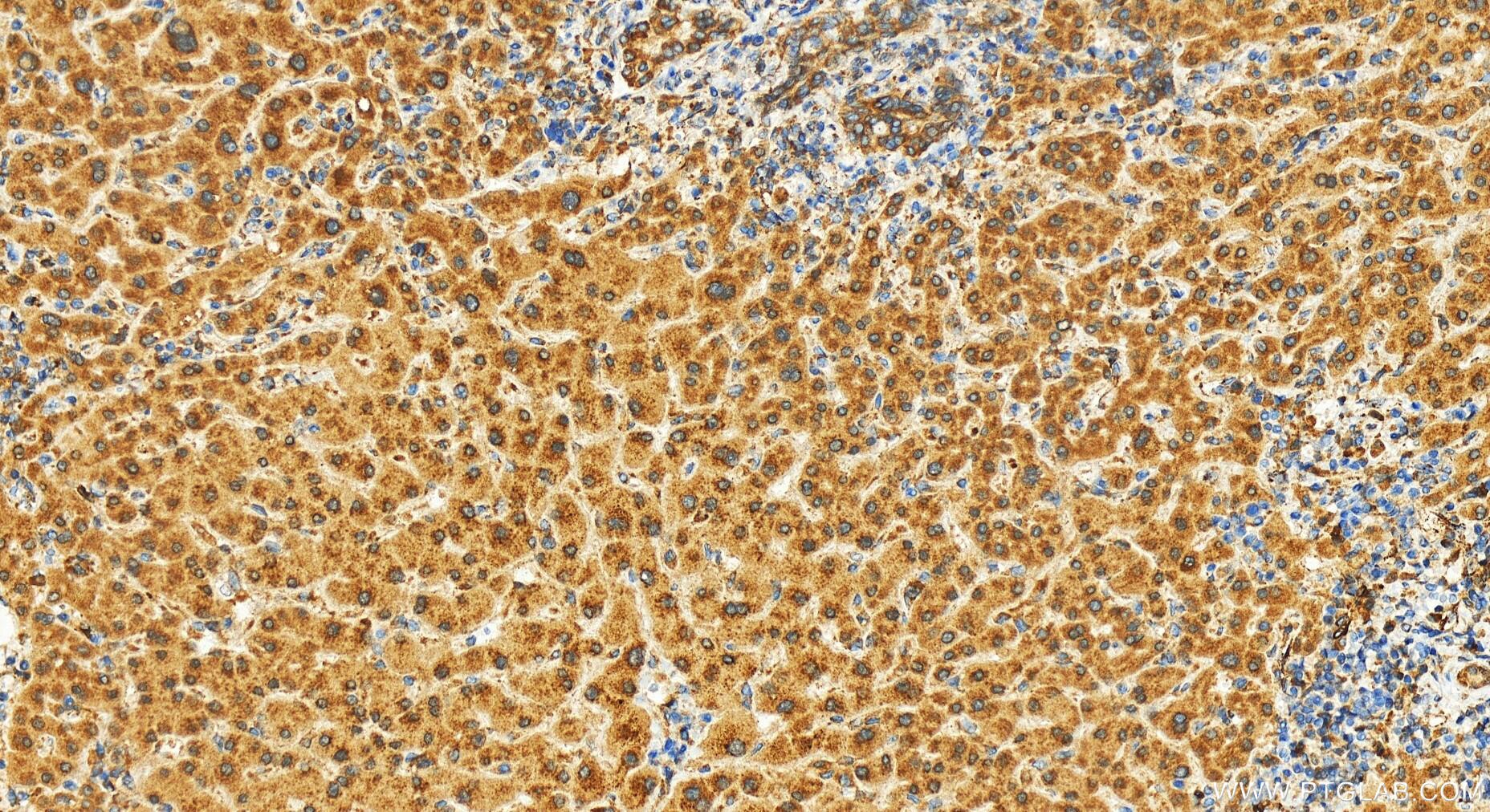 Immunohistochemistry (IHC) staining of human intrahepatic cholangiocarcinoma tissue using EMC7/C15orf24 Polyclonal antibody (27550-1-AP)