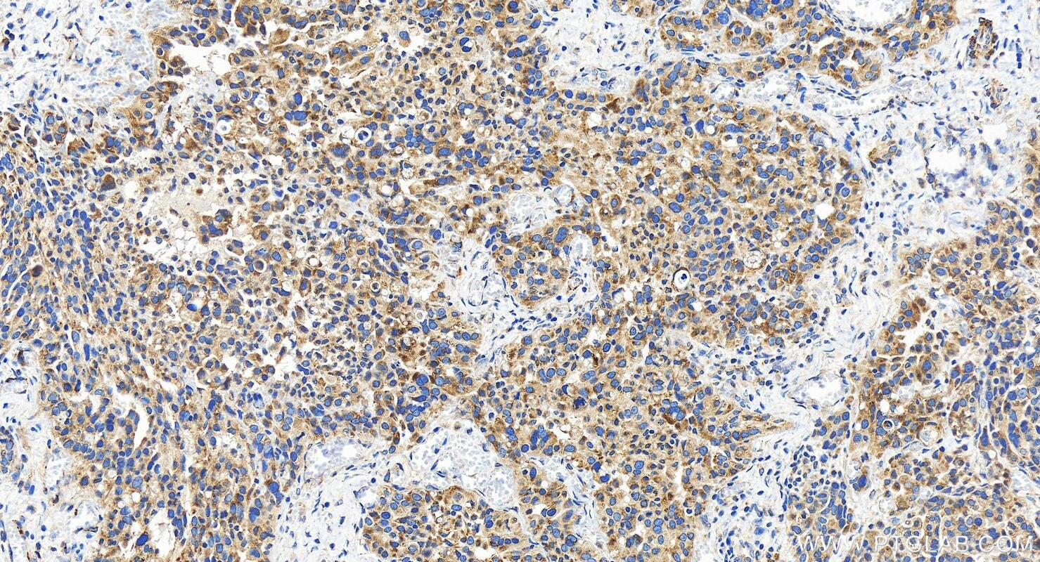 Immunohistochemistry (IHC) staining of human ovary cancer tissue using EMC7/C15orf24 Polyclonal antibody (27550-1-AP)