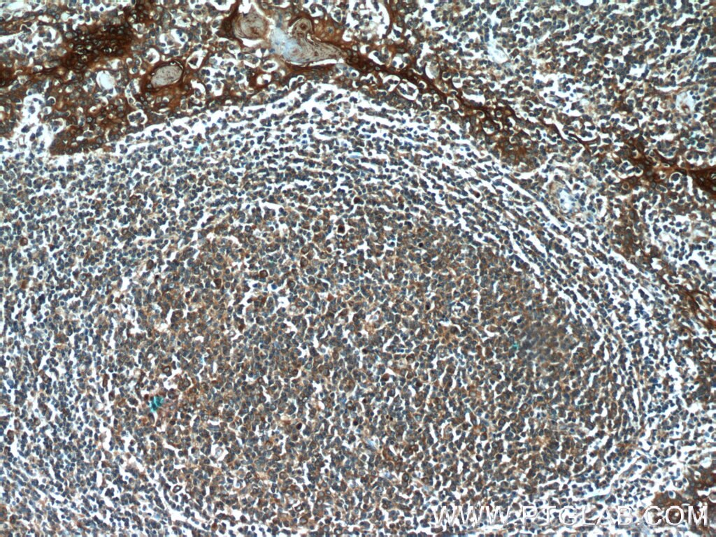 IHC staining of human tonsillitis using 24553-1-AP