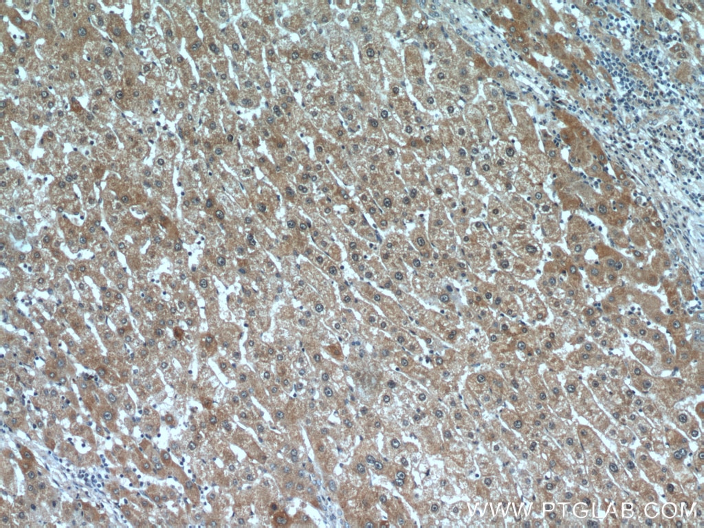 Immunohistochemistry (IHC) staining of human liver cancer tissue using C16orf70 Polyclonal antibody (20602-1-AP)
