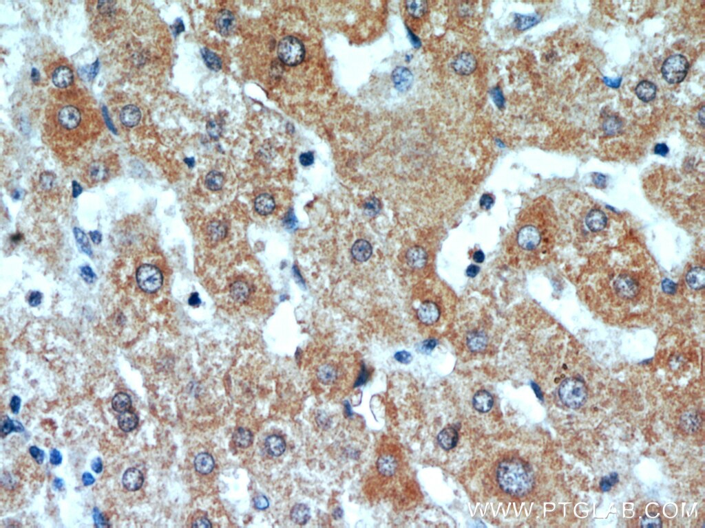 Immunohistochemistry (IHC) staining of human liver cancer tissue using C16orf70 Polyclonal antibody (20602-1-AP)