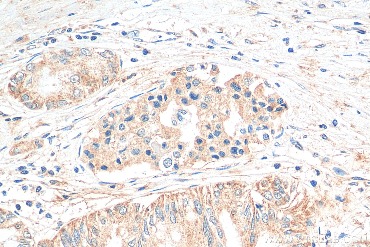 IHC staining of human pancreas cancer using 30246-1-AP Immunohistochemistry (IHC) staining of human pancreas cancer tissue using C16orf74 Polyclonal antibody (30246-1-AP)