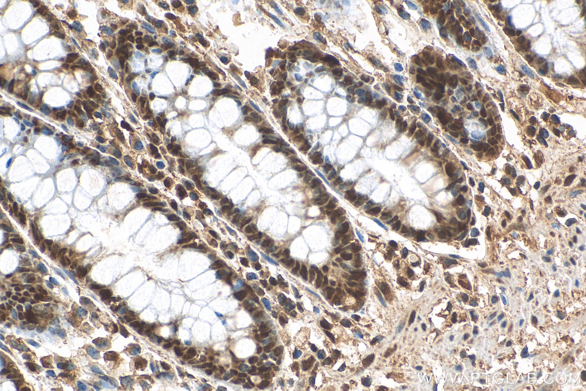 Immunohistochemistry (IHC) staining of human colon tissue using C17orf49 Polyclonal antibody (27114-1-AP)