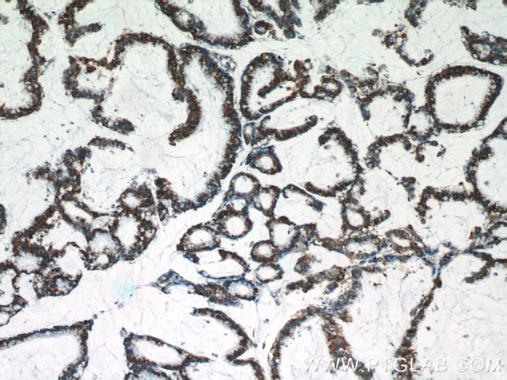 Immunohistochemistry (IHC) staining of human colon cancer tissue using C18orf21 Polyclonal antibody (24977-1-AP)