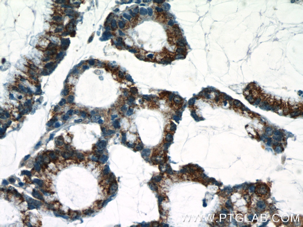 Immunohistochemistry (IHC) staining of human colon cancer tissue using C18orf21 Polyclonal antibody (24977-1-AP)