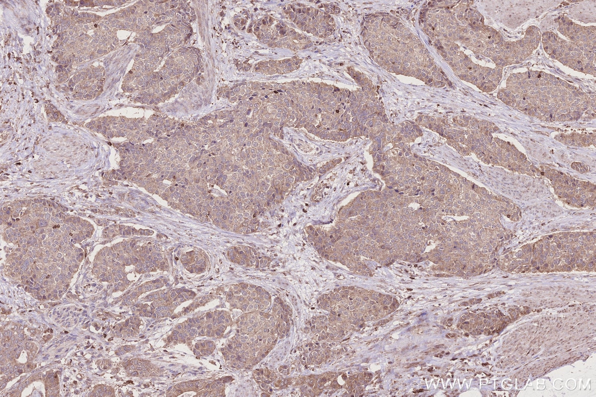 IHC staining of human stomach cancer using 31161-1-AP Immunohistochemistry (IHC) staining of human stomach cancer tissue using C18orf24 Polyclonal antibody (31161-1-AP)