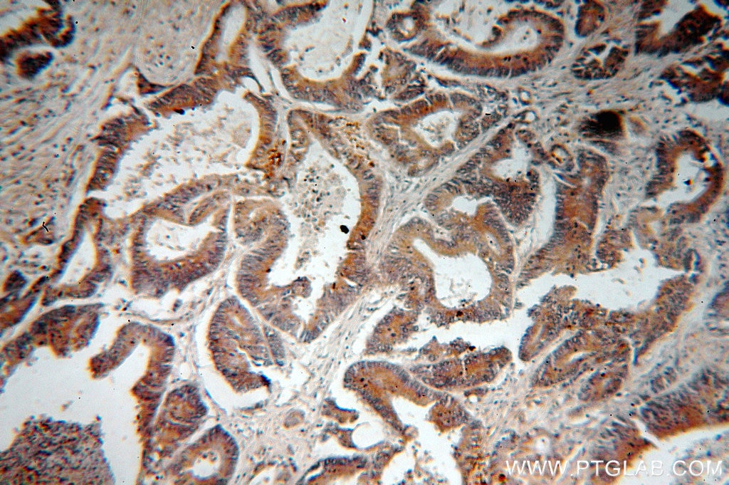 Immunohistochemistry (IHC) staining of human colon cancer tissue using RMC1 Polyclonal antibody (20111-1-AP)