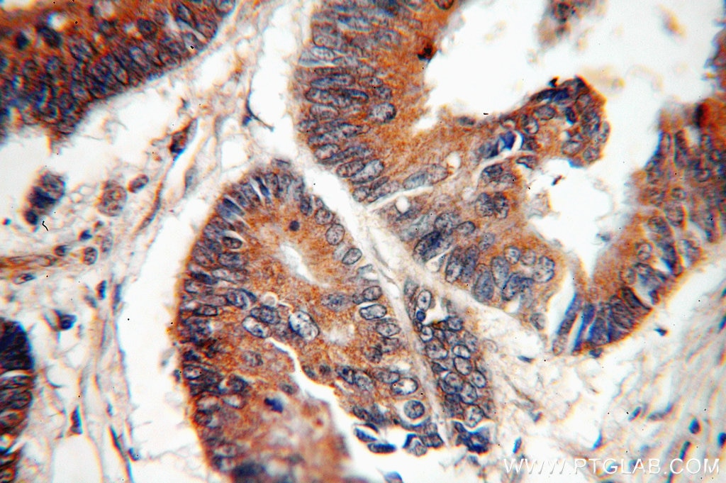 Immunohistochemistry (IHC) staining of human colon cancer tissue using RMC1 Polyclonal antibody (20111-1-AP)