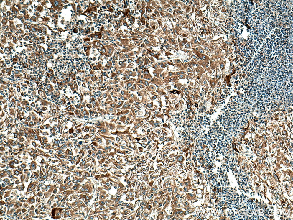 Immunohistochemistry (IHC) staining of human liver cancer tissue using MYDGF/C19orf10 Polyclonal antibody (11353-1-AP)