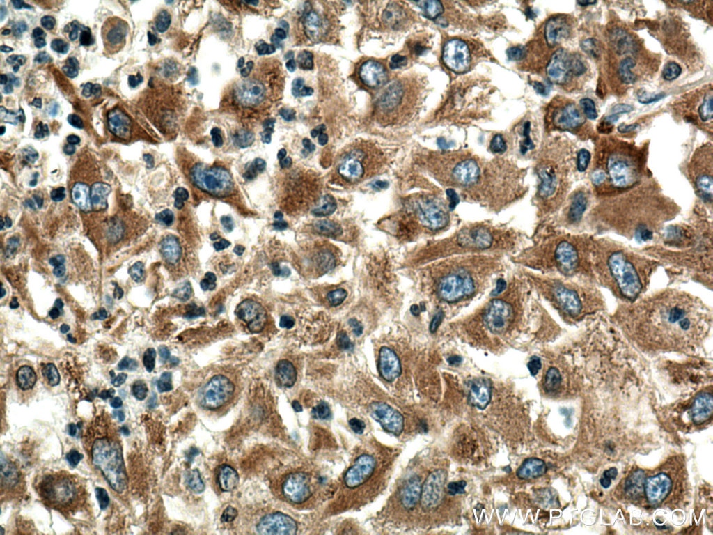 IHC staining of human liver cancer using 11353-1-AP