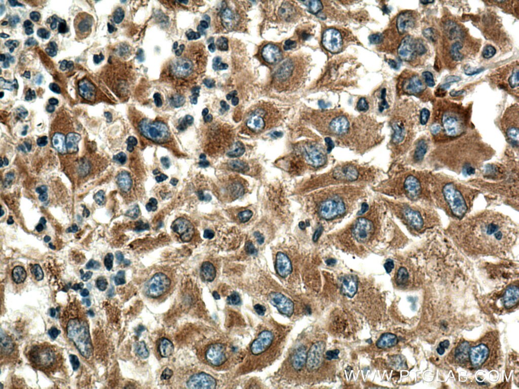 Immunohistochemistry (IHC) staining of human liver cancer tissue using MYDGF/C19orf10 Polyclonal antibody (11353-1-AP)