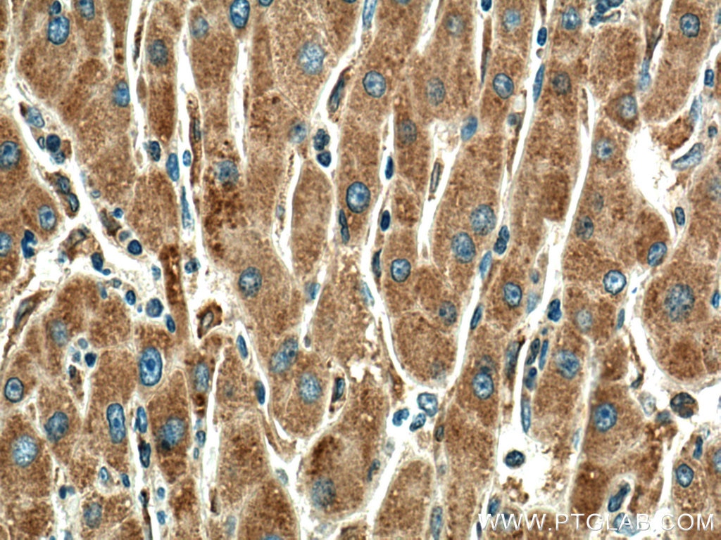 Immunohistochemistry (IHC) staining of human liver cancer tissue using MYDGF/C19orf10 Polyclonal antibody (11353-1-AP)