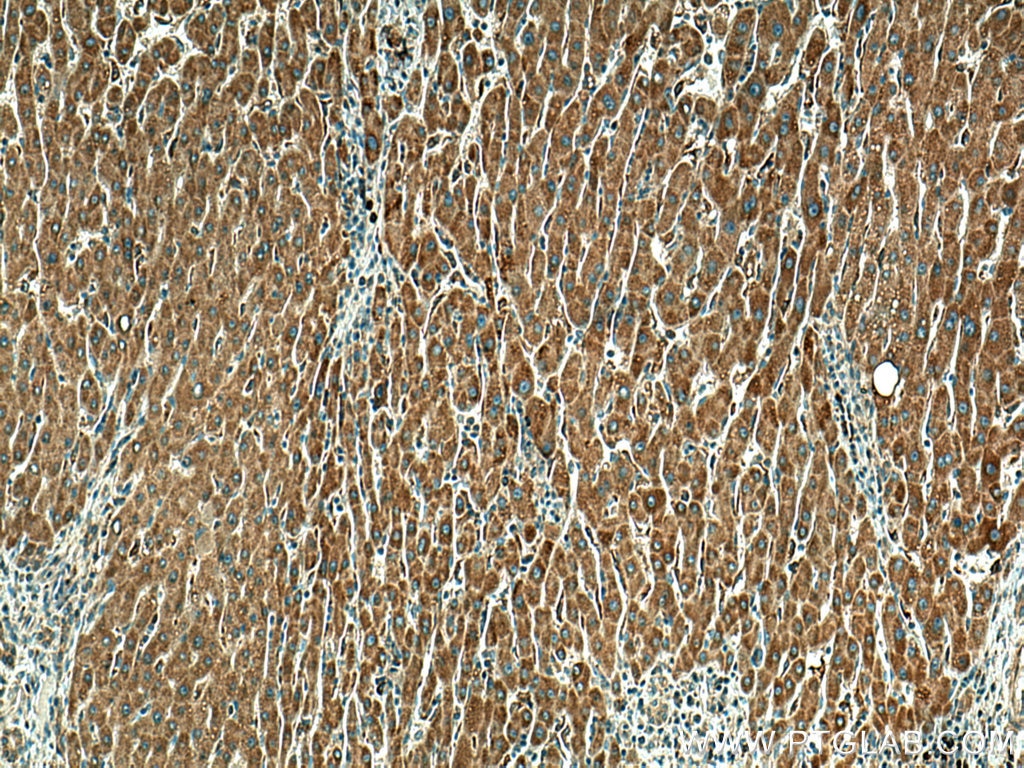 Immunohistochemistry (IHC) staining of human liver cancer tissue using MYDGF/C19orf10 Polyclonal antibody (11353-1-AP)