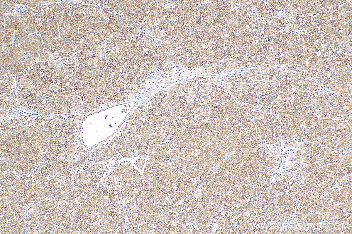Immunohistochemistry (IHC) staining of human liver cancer tissue using MYDGF/C19orf10 Monoclonal antibody (68131-1-Ig)