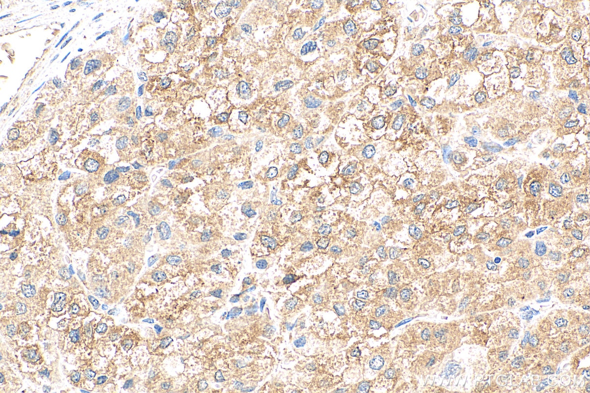 Immunohistochemistry (IHC) staining of human liver cancer tissue using MYDGF/C19orf10 Monoclonal antibody (68131-1-Ig)