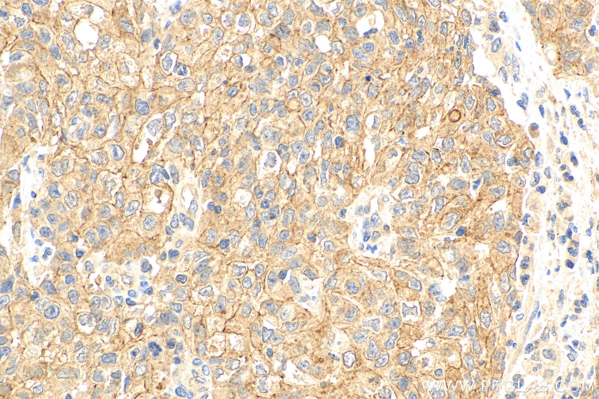 Immunohistochemistry (IHC) staining of human stomach cancer tissue using C19orf12 Polyclonal antibody (27382-1-AP)