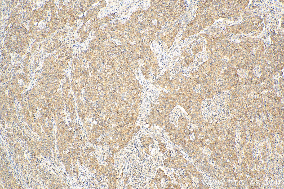 Immunohistochemistry (IHC) staining of human stomach cancer tissue using C19orf12 Polyclonal antibody (27382-1-AP)